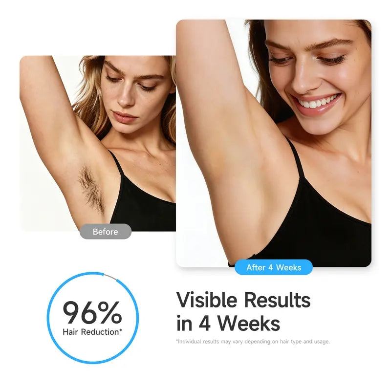 MLAY T15 IPL Hair Removal Device with Ice Cooling,Intelligent Skin Tone Recognition,5 Energy Levels, 2 Modes,Plug-In Design