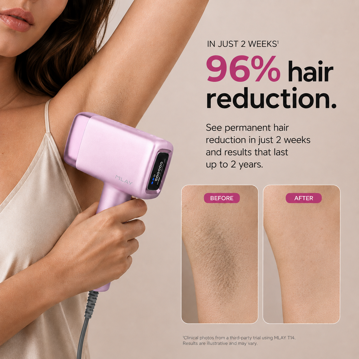 MLAY T14A Ice Cooling IPL Hair Removal Device-High Energy Replaceable Head-Pink