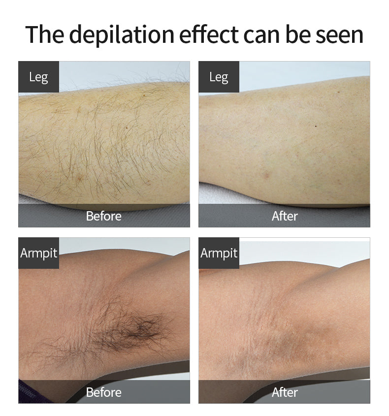 IPL hair removal FDA & SFDA & CFDA medical certified 100% safe T2